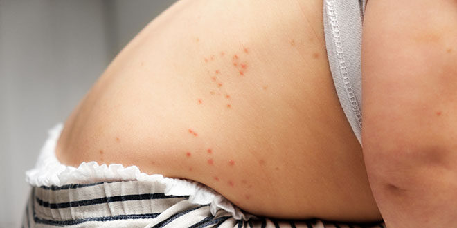 Škrlatinka pri otroku